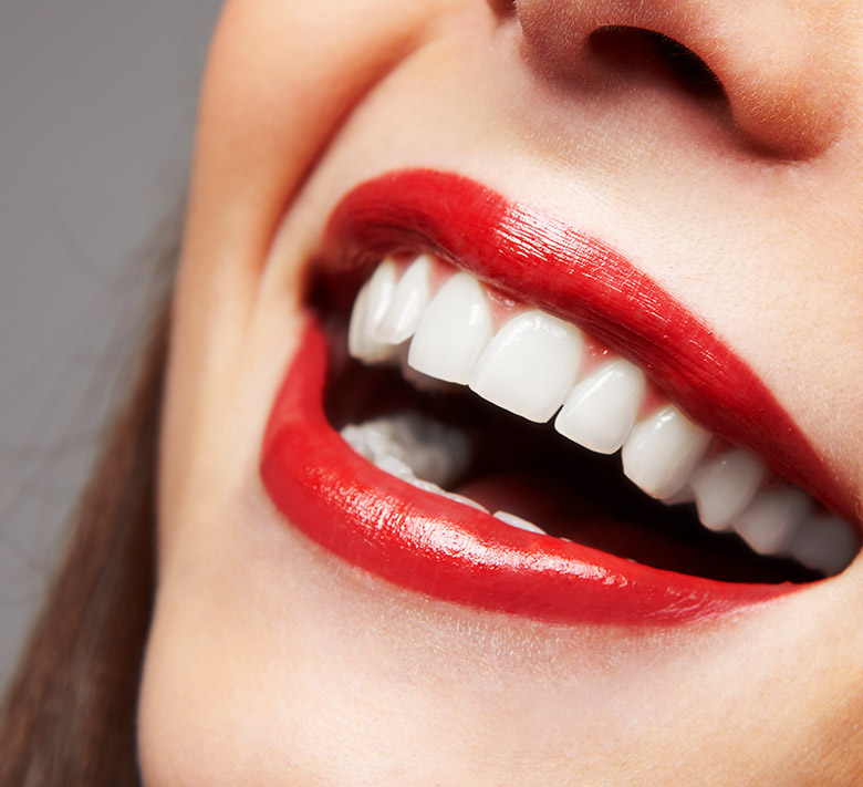 Veneers in Brighton