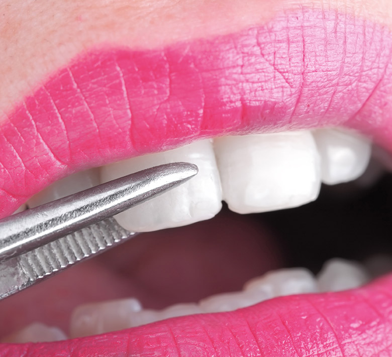 Dental veneers in Brighton